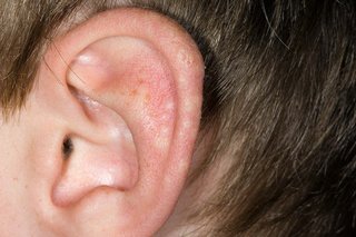 Juvenile spring eruption on white skin. There are some small, white blisters on an ear. The skin around them is slightly pink.