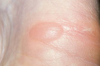 An oval-shape bump on white skin that's filled with clear fluid. The skin over the blister is pink and shiny.