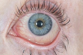 A red and watery eye caused by conjunctivitis