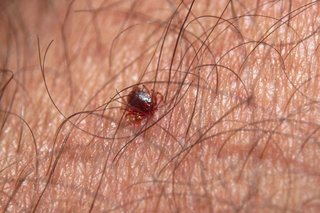 A red-brown tick on white skin, surrounded by brown hairs. The tick has a small oval body and 8 legs.