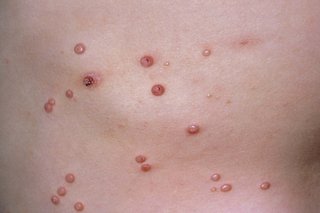 About 20 raised, pink to brown spots caused by molluscum contagiosum. Shown on white skin.