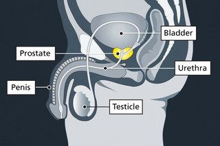 Diagram showing the prostate, which is a small gland just under the bladder. It surrounds the urethra, which is a tube from the bladder to the penis.